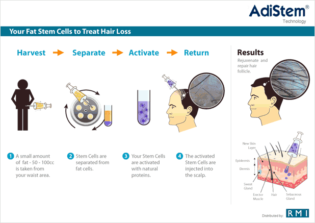 Diagram Hair Loss - Man