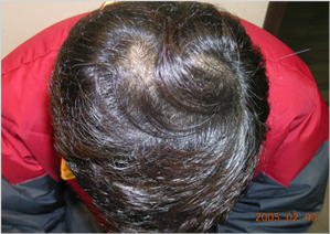 treatment for hair restoration