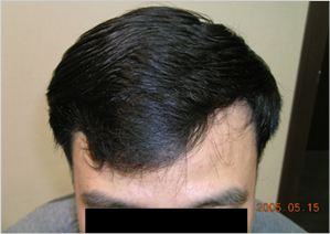 treatment for hair restoration