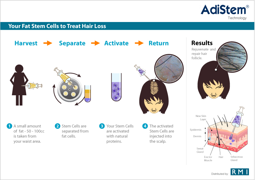 Treatment for Hair Restoration | Stem Cell Therapy for Hair Restoration