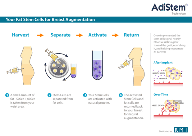 Diagram Breast Augmentation