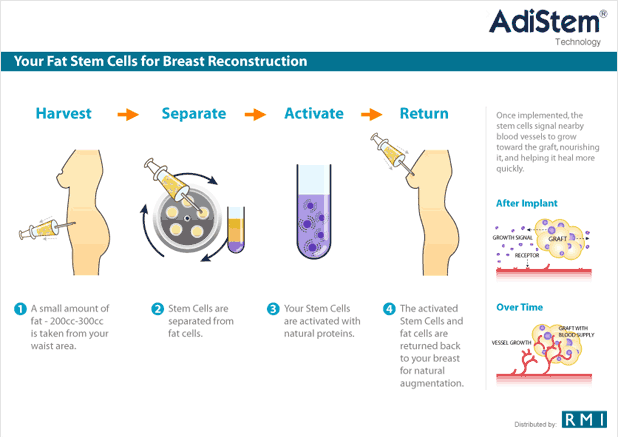 Diagram Breast Reconstruction