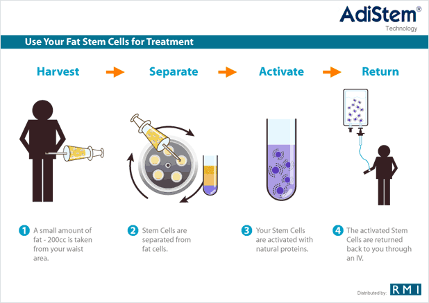 Diagram Fat Stem Cells Treatment