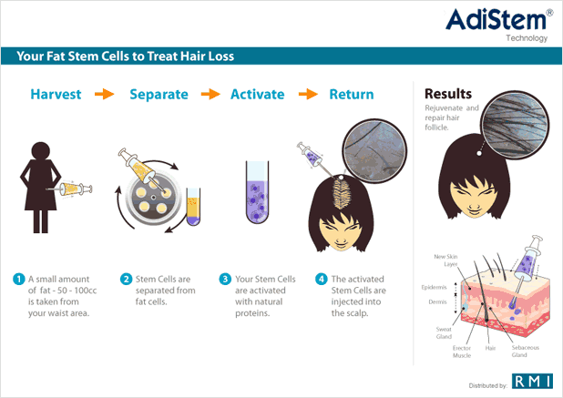 Diagram Hair Loss - Woman