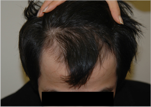 treatment for hair restoration