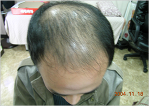 case studies for hair restoration