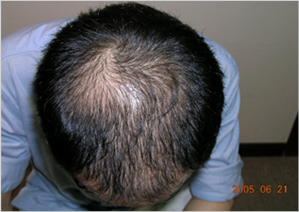 treatment for hair restoration