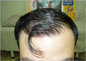 case studies for hair restoration